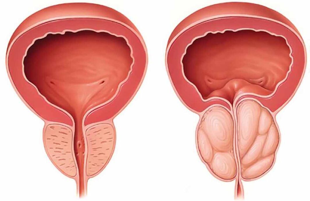 Нормална простата и възпаление на простатната жлеза (хроничен простатит)