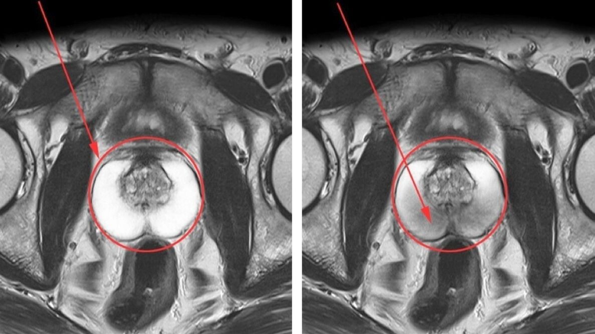 Ултразвук за хроничен простатит – здрава простата (вляво) и възпалена (вдясно)